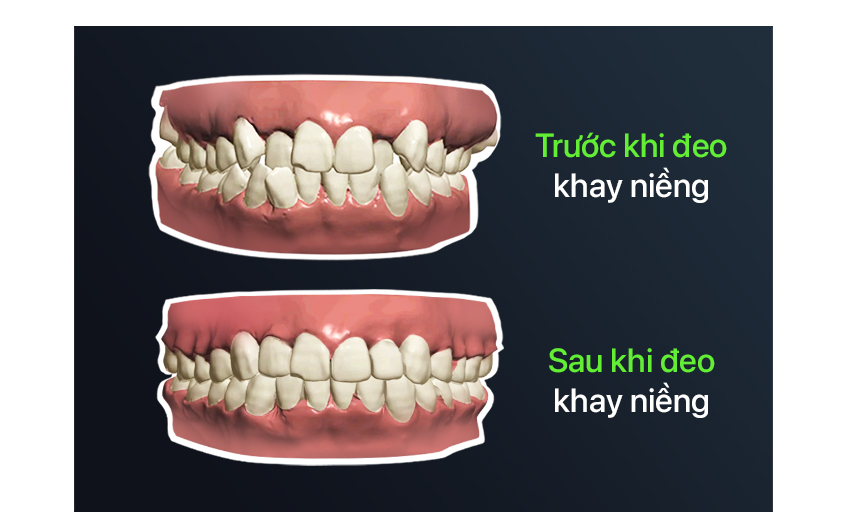 niềng răng trong suốt hay mắc cài, niềng răng trong suốt, có nên niềng răng trong suốt, niềng răng trong suốt là gì, niềng răng trong suốt hà nội, niềng răng trong suốt, niềng răng vô hình