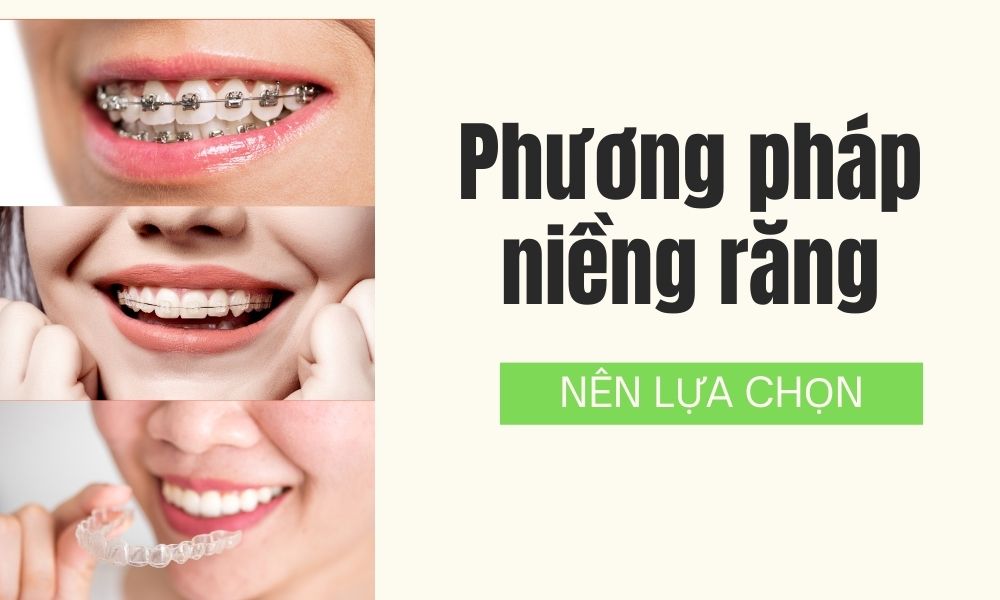 Phương pháp niềng răng nên lựa chọn