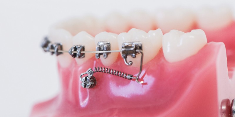 cắm vít khi niềng răng