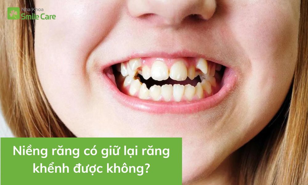 Niềng răng có giữ lại răng khểnh
