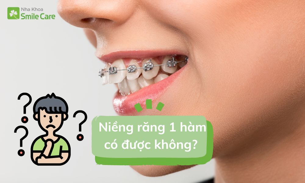 Niềng răng 1 hàm