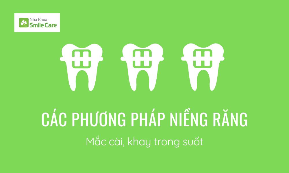 Các phương pháp niềng răng