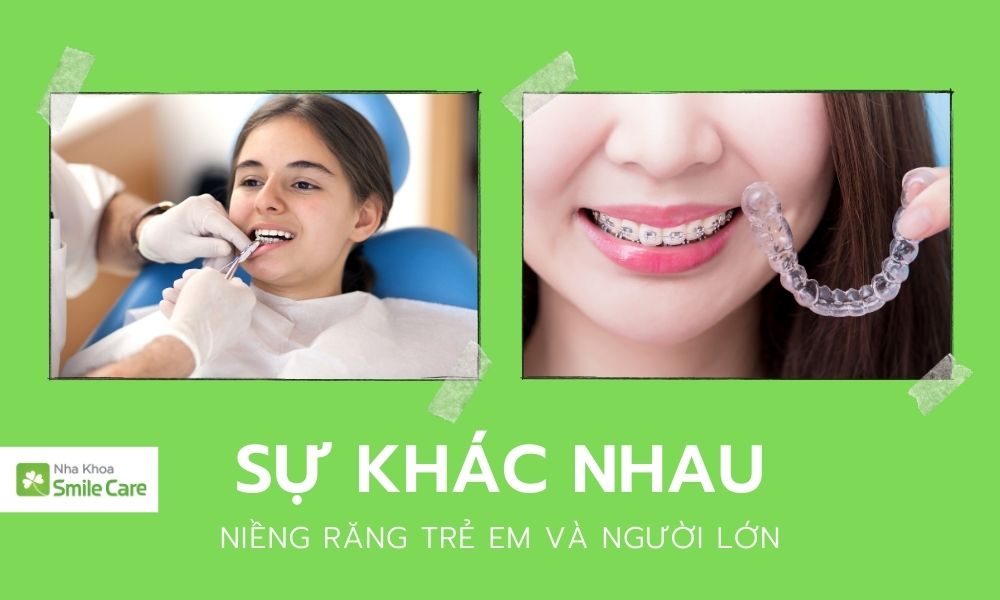 Sự khác nhau giữa niềng răng trẻ em và người lớn