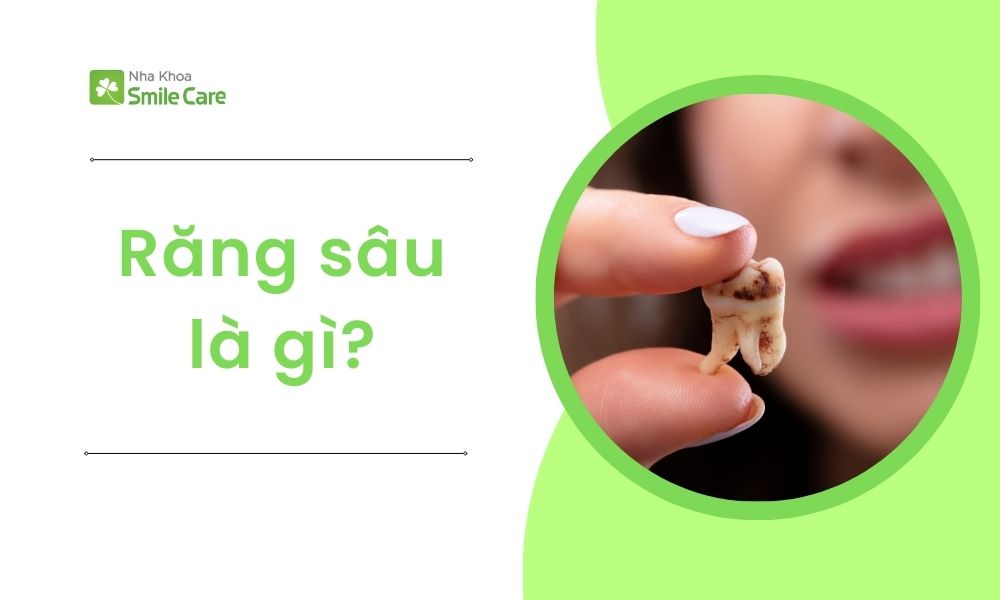 Sâu răng là gì?