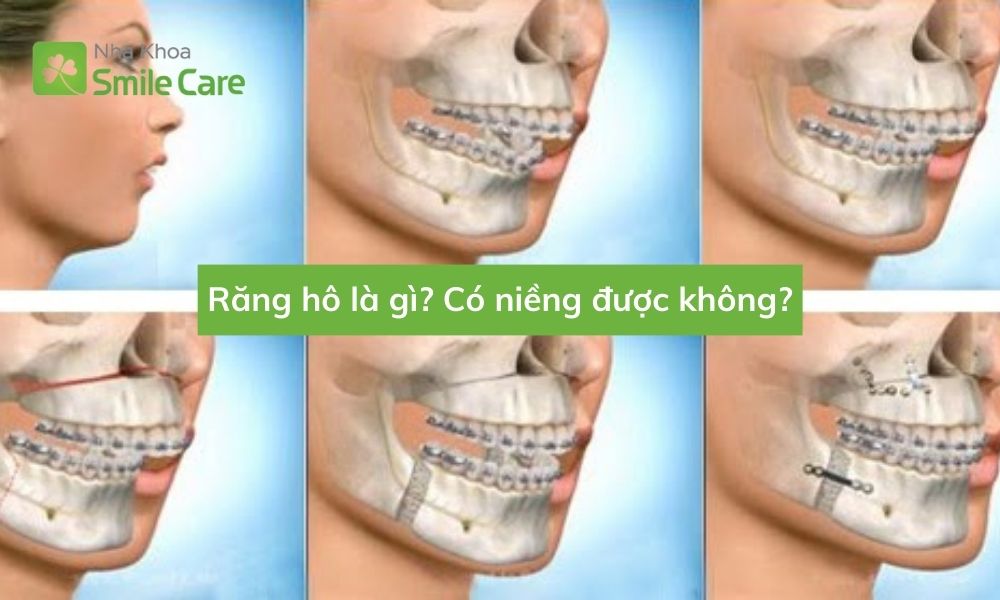 Răng hô có niềng được? 