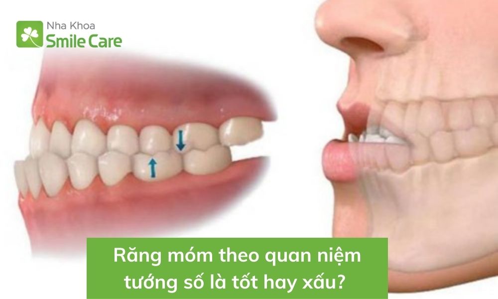 Răng móm quan niệm tướng số 