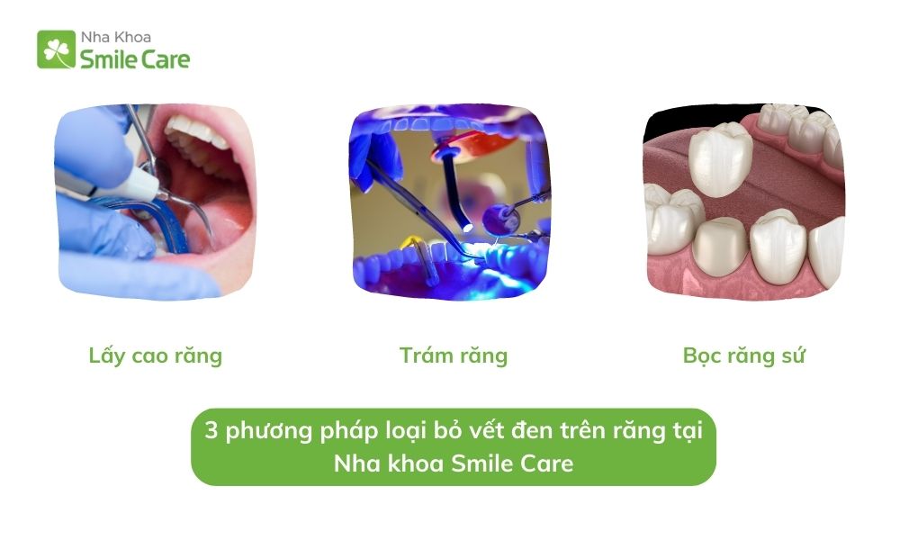 phương pháp loại bỏ vết đen trên răng 