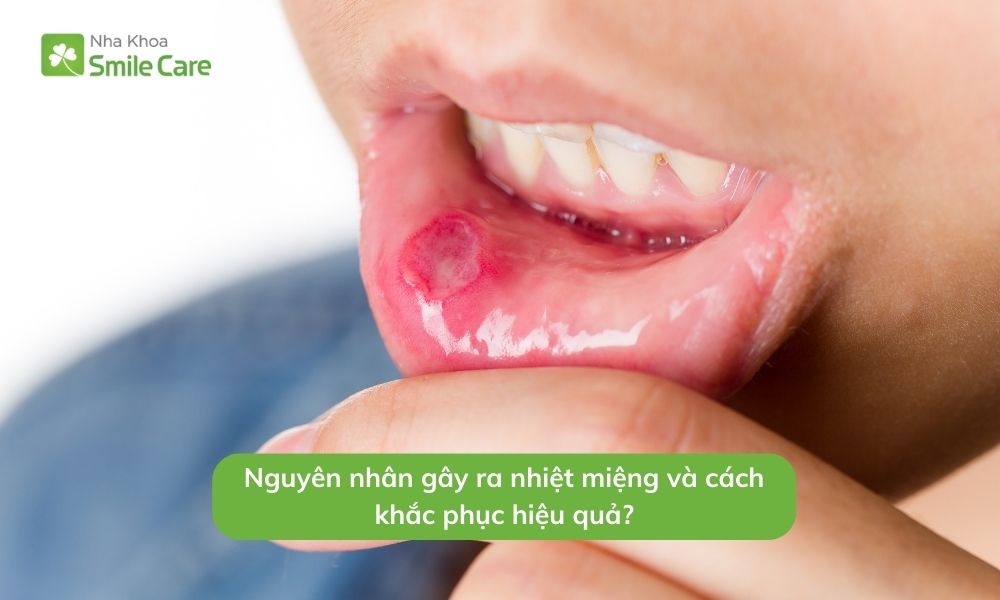 Nguyên nhân gây ra nhiệt miệng