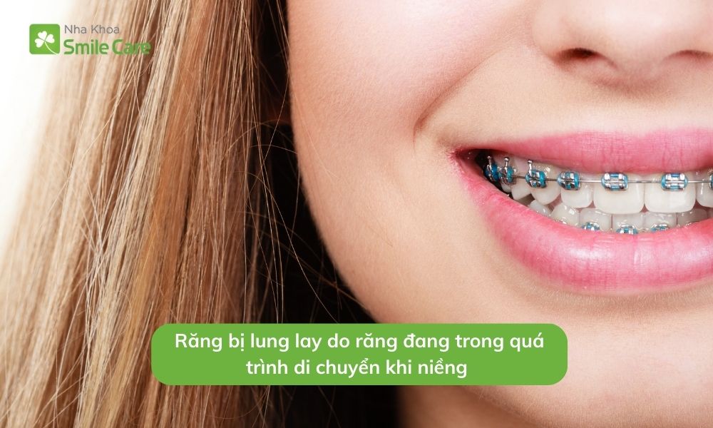 Răng bị lung lay khi niềng