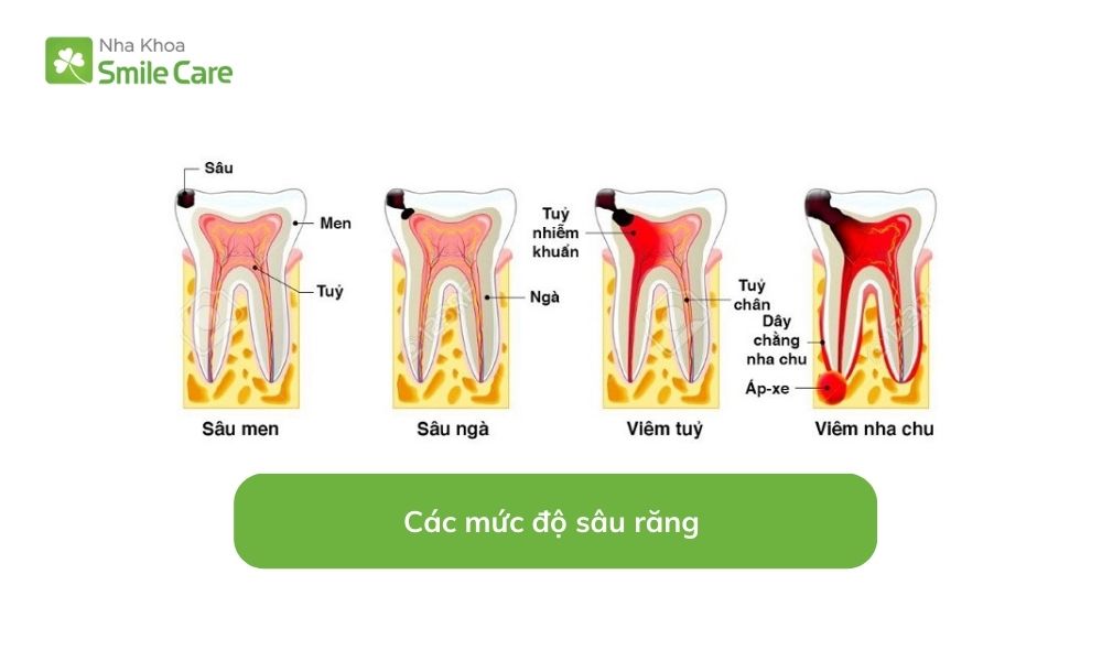 mức độ sâu răng 