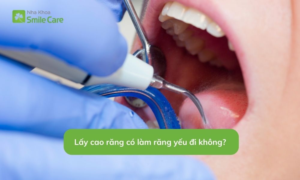 Lấy cao răng có làm răng yếu