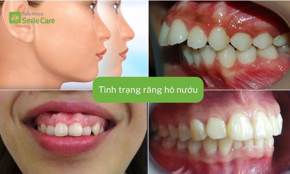 hô nướu