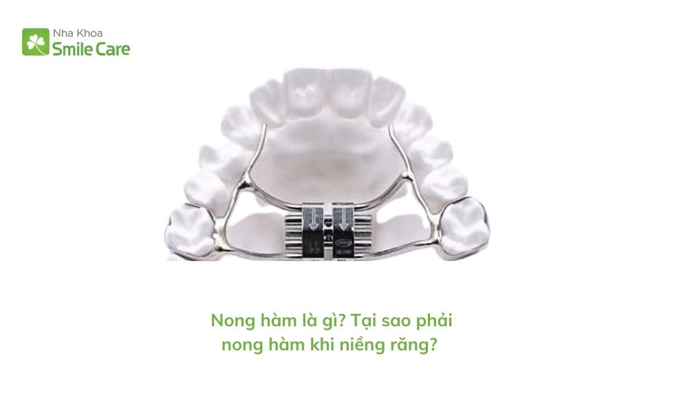 Tại sao phải nong hàm khi niềng răng? 