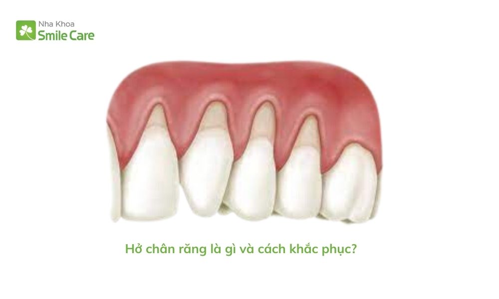 Hở chân răng 