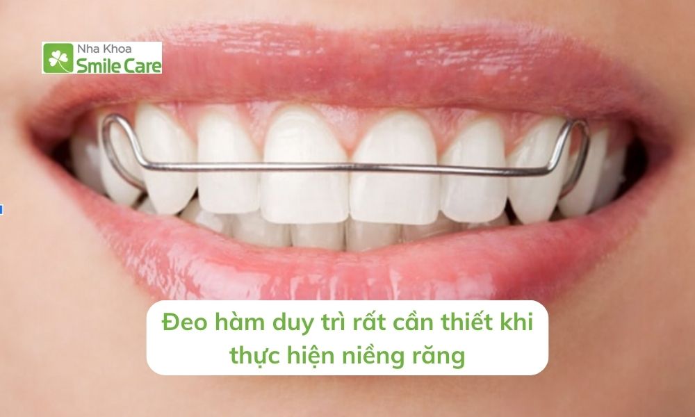 Đeo hàm duy trì rất cần thiết