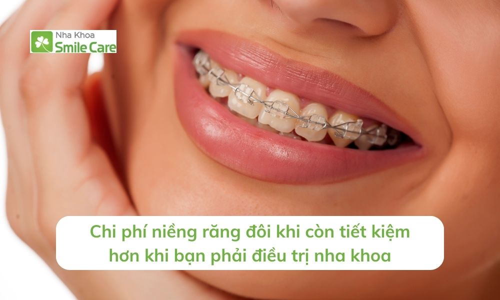 Chi phí niềng răng đôi khi còn tiết kiệm hơn