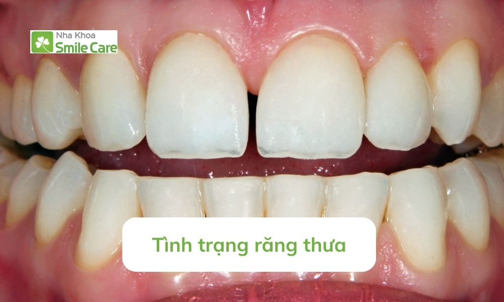 Răng thưa là gì?