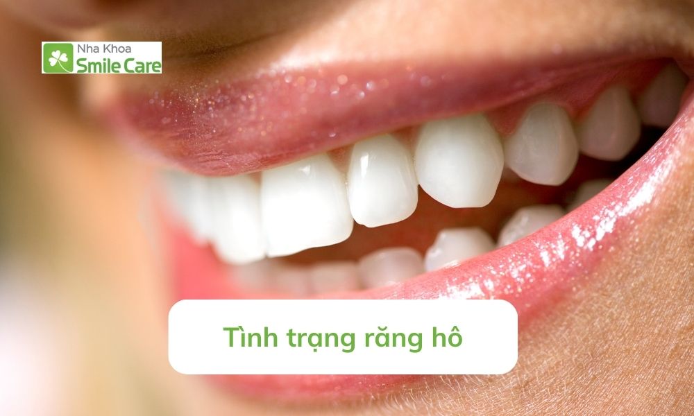 Tình trạng răng
