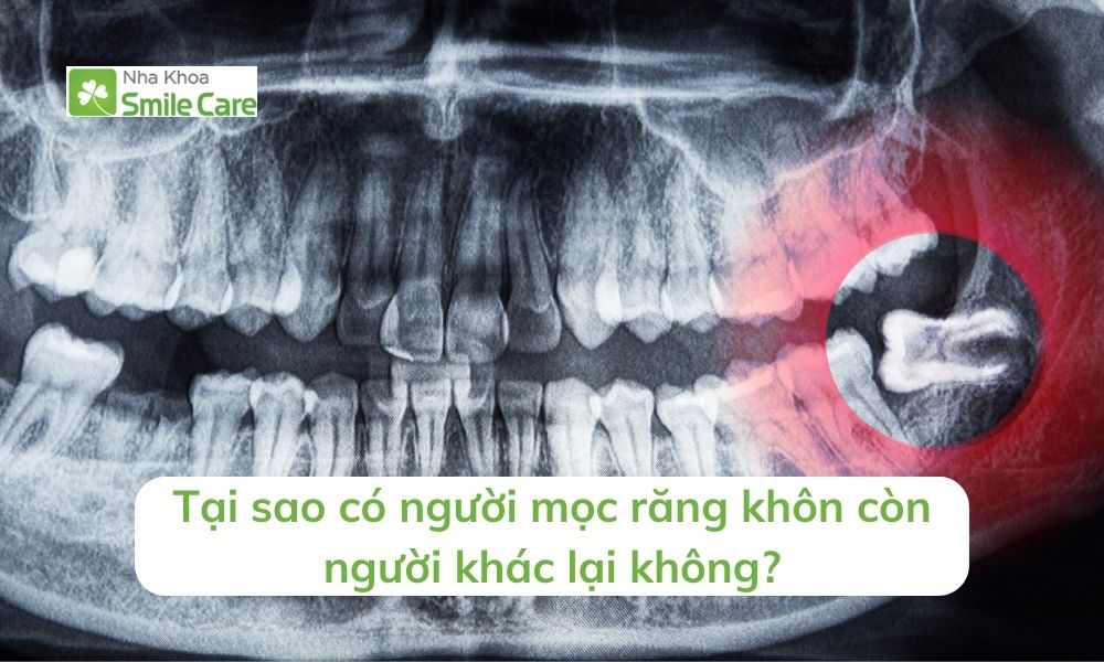 Có người mọc răng khôn còn người khác lại không?
