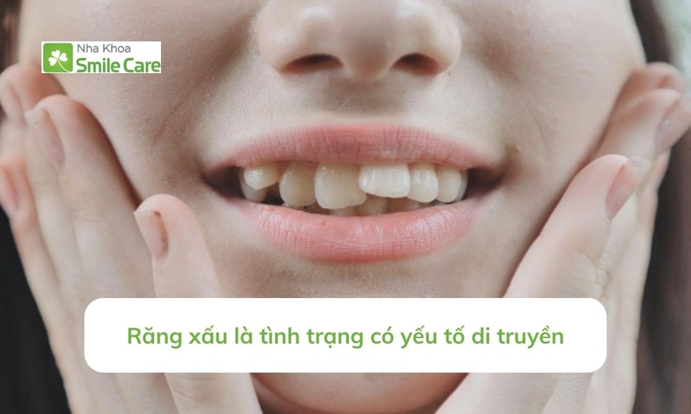 Răng xấu do yếu tố di truyền