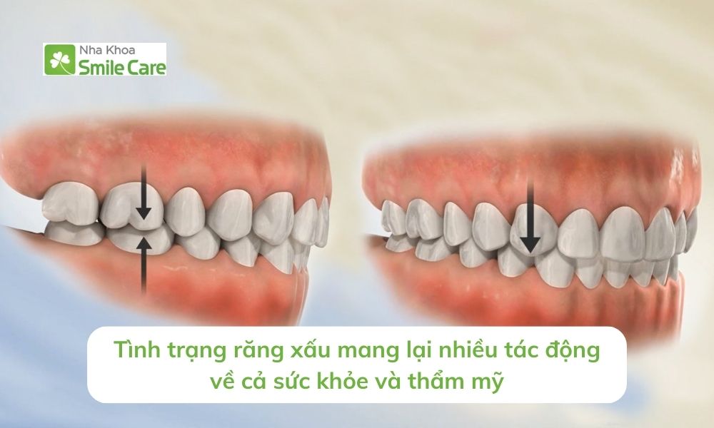 Tình trạng răng xấu mang lại nhiều tác động về cả sức khỏe 