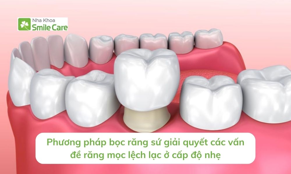 Phương pháp bọc răng sứ giải quyết các vấn đề răng mọc lệch lạc 
