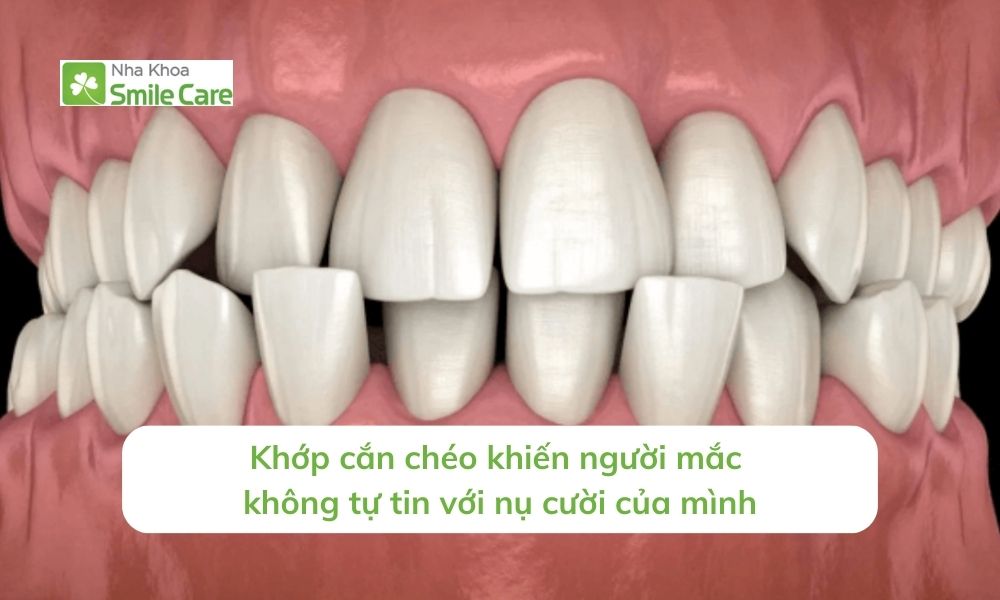 Khớp cắn chéo khiến không tự tin với nụ cười của mình
