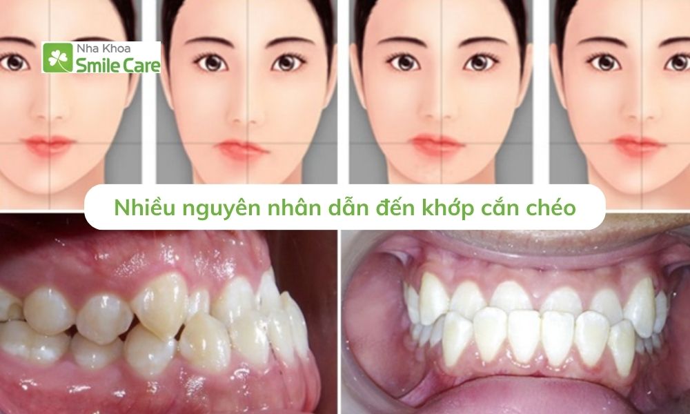 nguyên nhân dẫn đến khớp cắn chéo