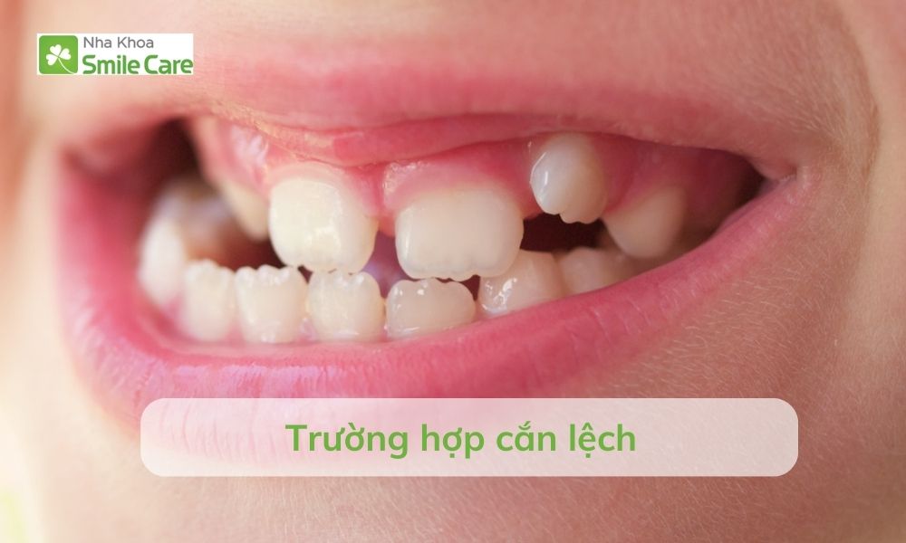 Răng cắn lệch 