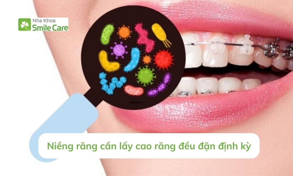 Niềng răng cần lấy cao răng đều đặn