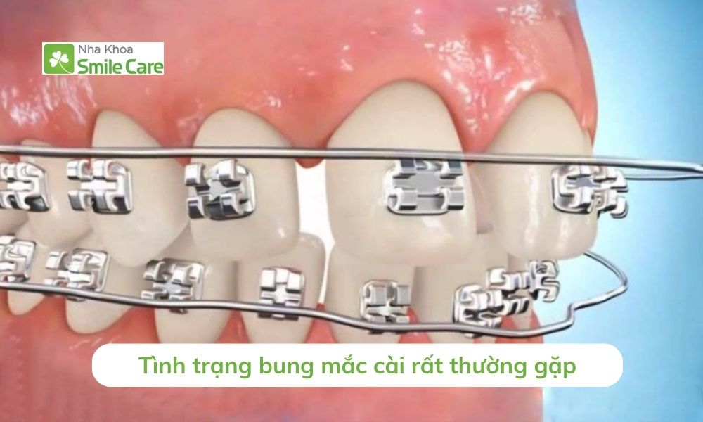 Tình trạng bung mắc cài 