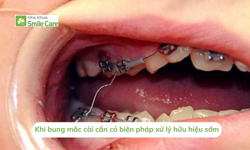 Khi bung mắc cài cần có biện pháp xử lý hữu hiệu 