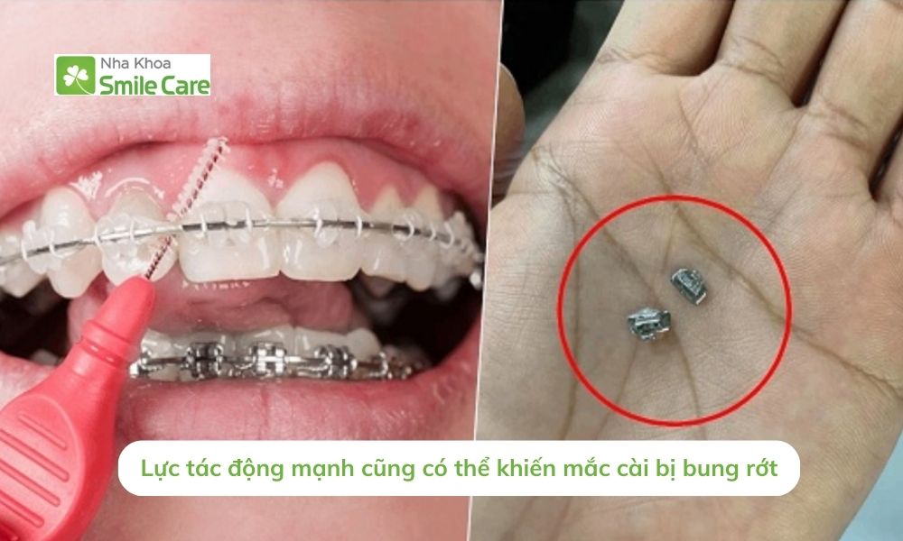 Lực tác động mạnh có thể khiến mắc cài bị bung rớt