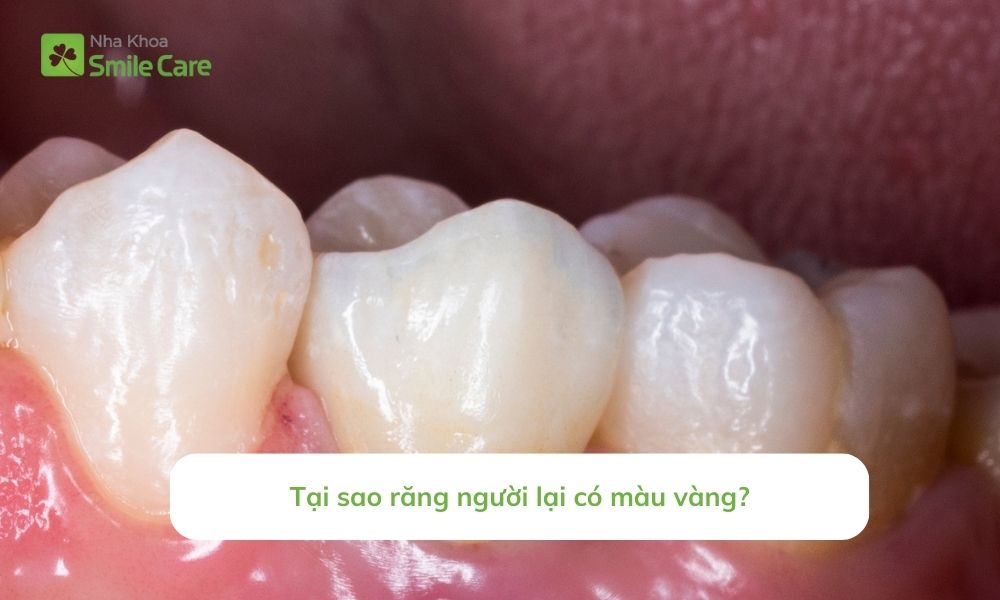 Răng người xỉn vàng