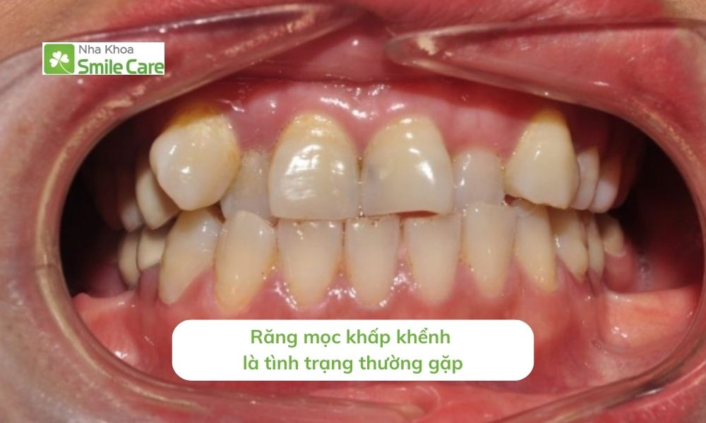 Răng khấp khểnh là tình trạng thường gặp