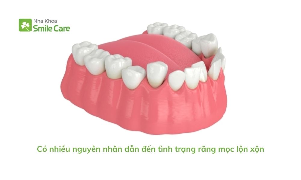 nguyên nhân dẫn đến tình trạng răng mọc lộn xộn