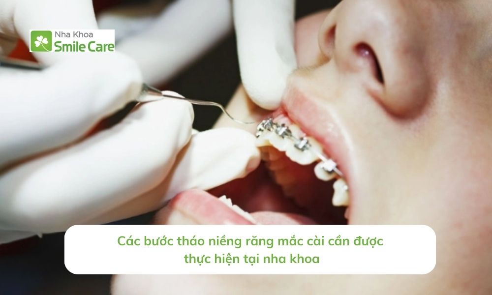 Các bước tháo niềng răng mắc cài