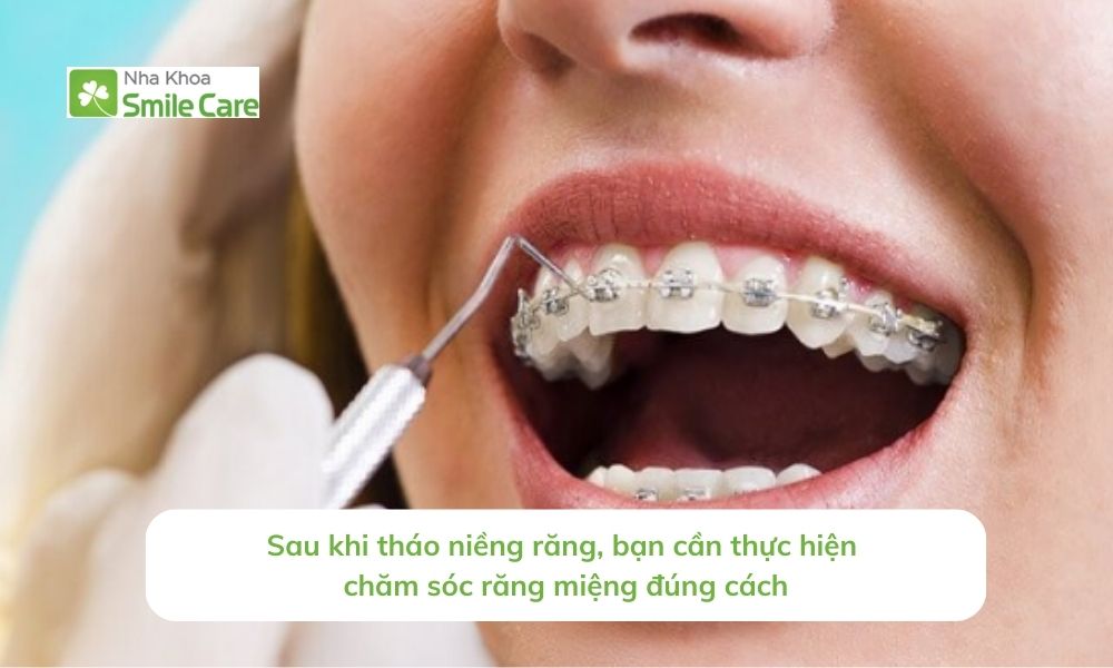 Sau khi tháo niềng răng, bạn cần thực hiện chăm sóc răng miệng đúng cách