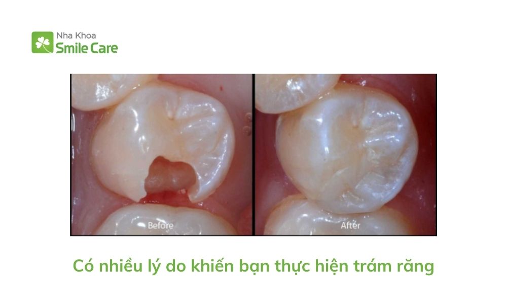 Nhiều lý do khiến bạn thực hiện trám răng