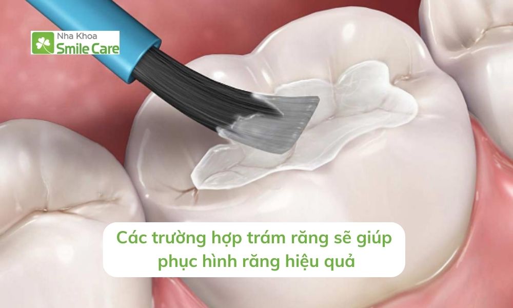 Các trường hợp trám răng sẽ giúp phục hình răng