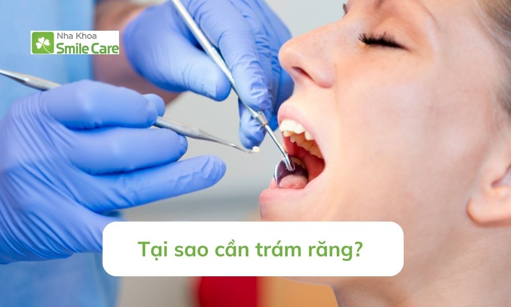 Sao cần trám răng?