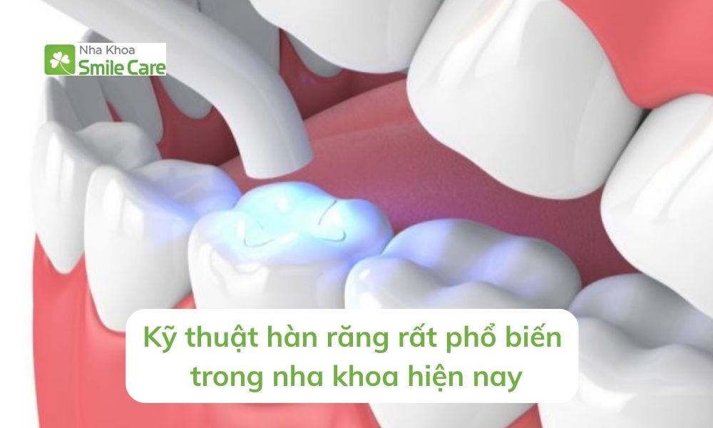 Kỹ thuật hàn răng rất phổ biến trong nha khoa