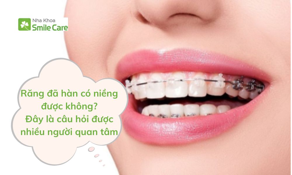 Răng đã hàn có niềng được không là câu hỏi được nhiều người quan tâm.