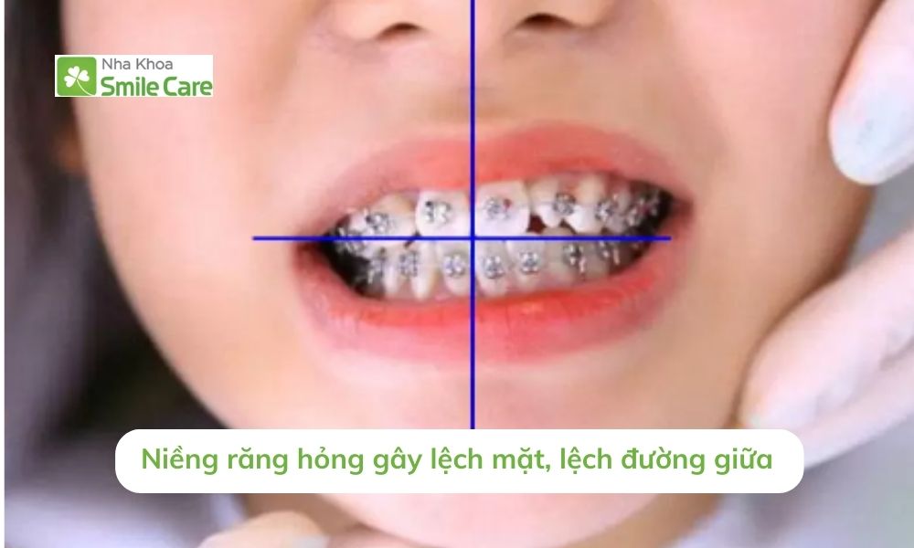Niềng răng hỏng gây lệch mặt, đường giữa