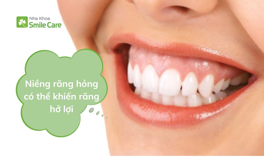 Niềng răng hỏng khiến răng hở lợi