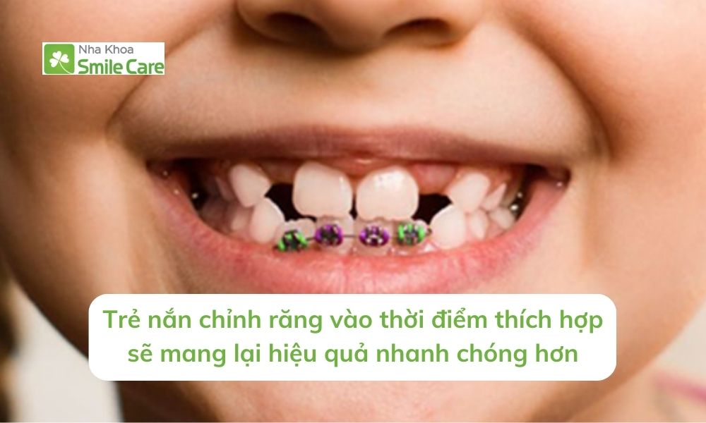 Trẻ nắn chỉnh răng vào thời điểm thích hợp sẽ mang lại hiệu quả