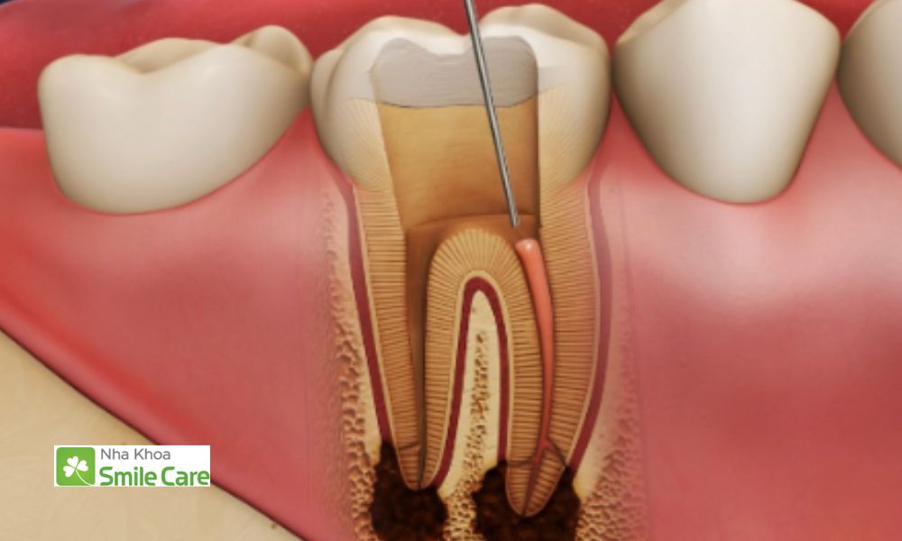 Niềng răng hỏng gây chết tủy răng nghiêm trọng