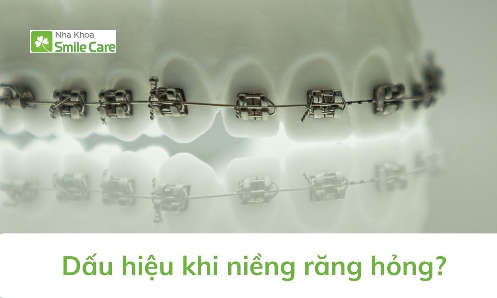 Dấu hiệu niềng răng hỏng