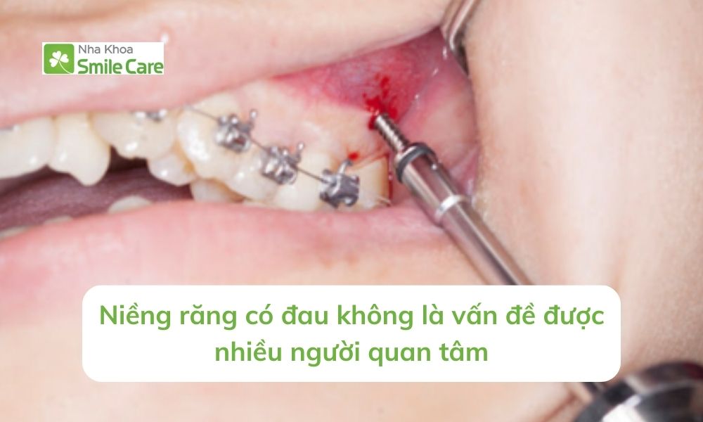 Niềng răng có đau không