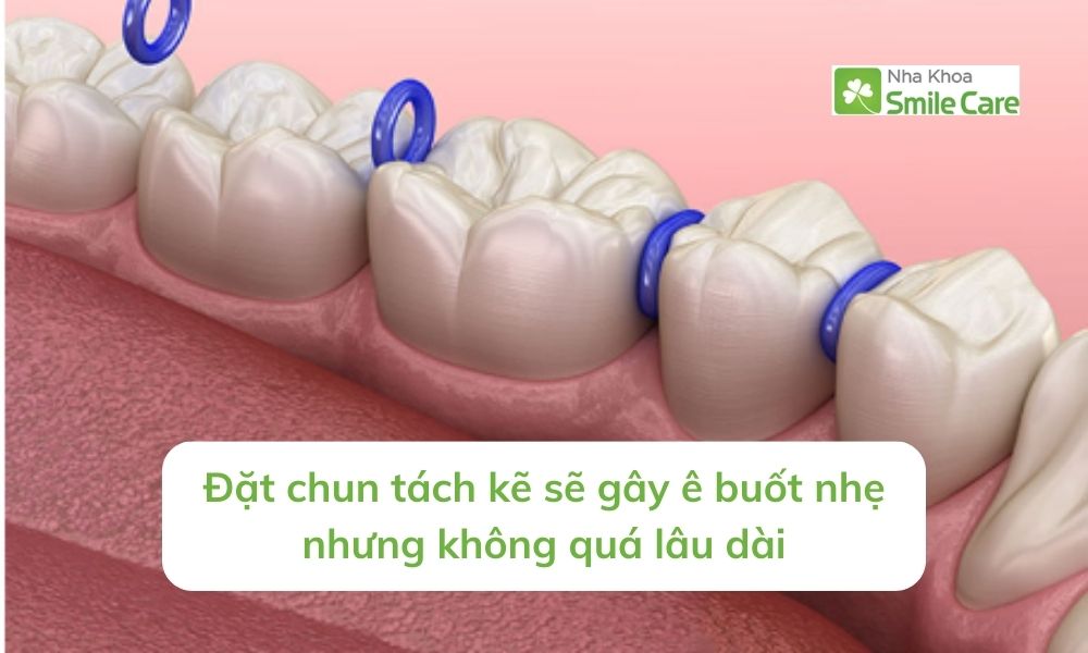 Đặt chun tách kẽ sẽ gây ê buốt nhẹ